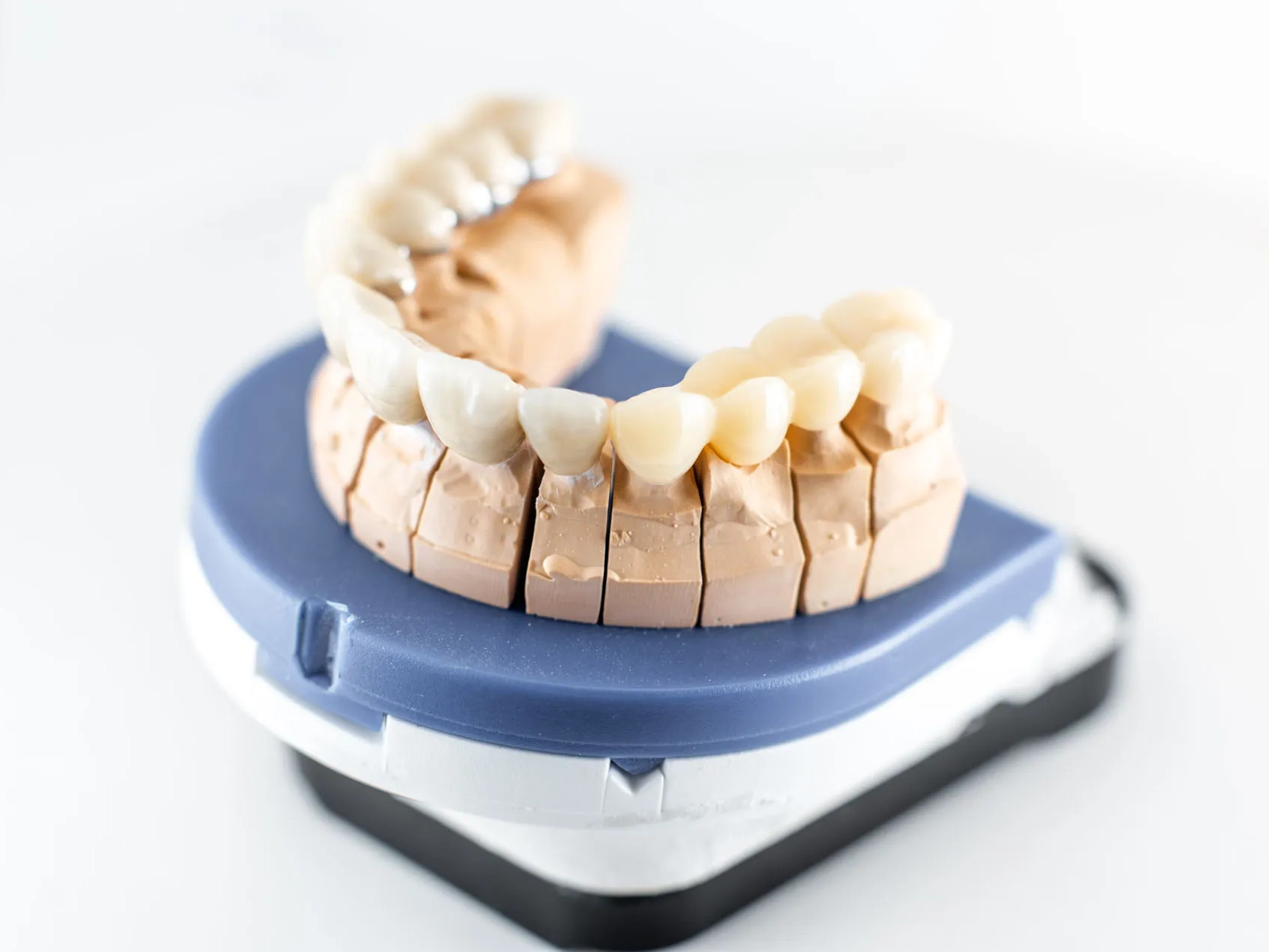 protesis_dental_fija_circonio